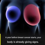 Breast cancer: 4 early signs every woman should know.