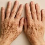 When a Spot on Your Hand Deserves a Second Look