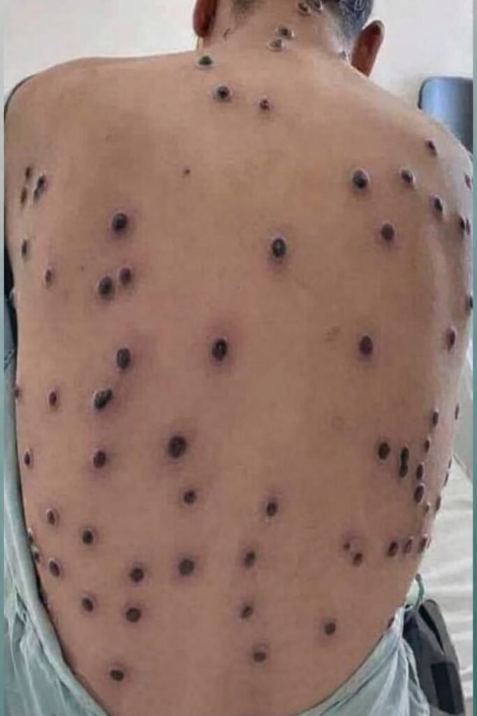 When Acne Becomes More Than “Just a Skin Problem” — What Dermatologists Want Everyone to Know