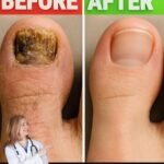 Before and After: What Really Helps With Toenail Fungus at Home