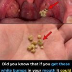 Tonsil Stones: What They Are, Why They Form, and How to Prevent Them for Good