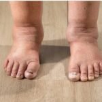 Why Swollen Ankles in the Evening May Be Your Body’s Way of Asking for Attention