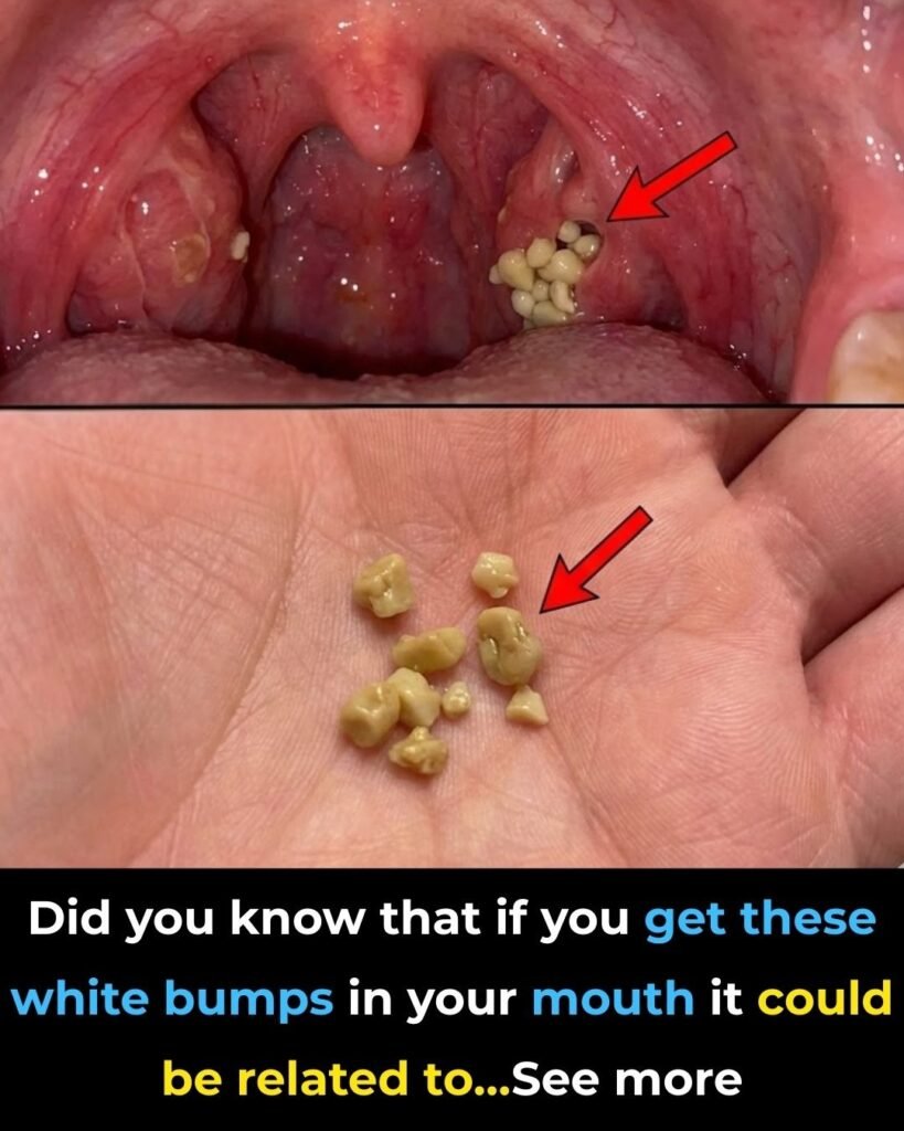 Tonsil Stones Explained: What They Are, Why They Form, and When to Take Them Seriously