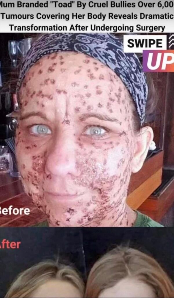 Woman With Rare Disorder Causing Thousands of Tumors Shares Life-Changing Improvement After Treatment