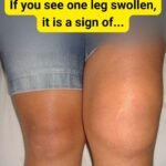 One Swollen Leg Isn’t Random — It Can Signal Something Serious